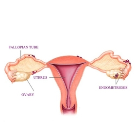 Endometriosis in Delhi